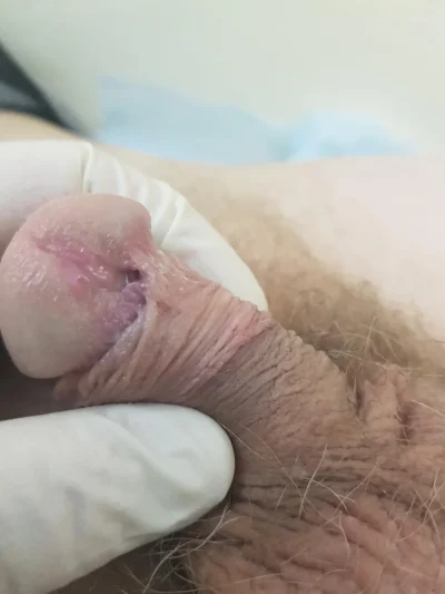 Головчатая гипоспадия