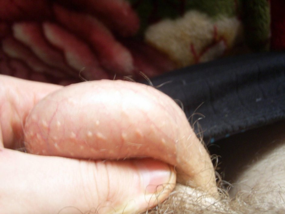 Язвочки на коже полового члена