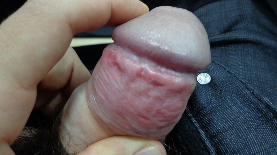 Головка члена белая