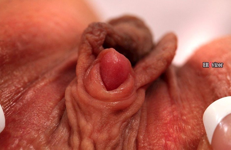 Hemorrhoids treatment