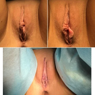 Пластика влагалища вагинопластика кольпорафия