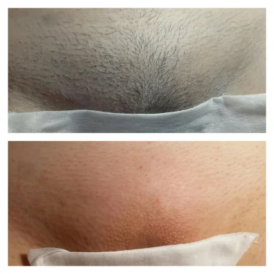 Зона бикини эпиляция классическое