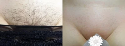 Эпиляция бикини