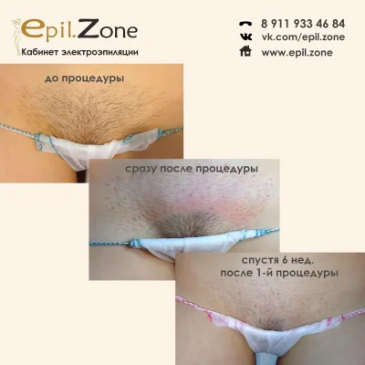 Лазерная эпиляция бикини