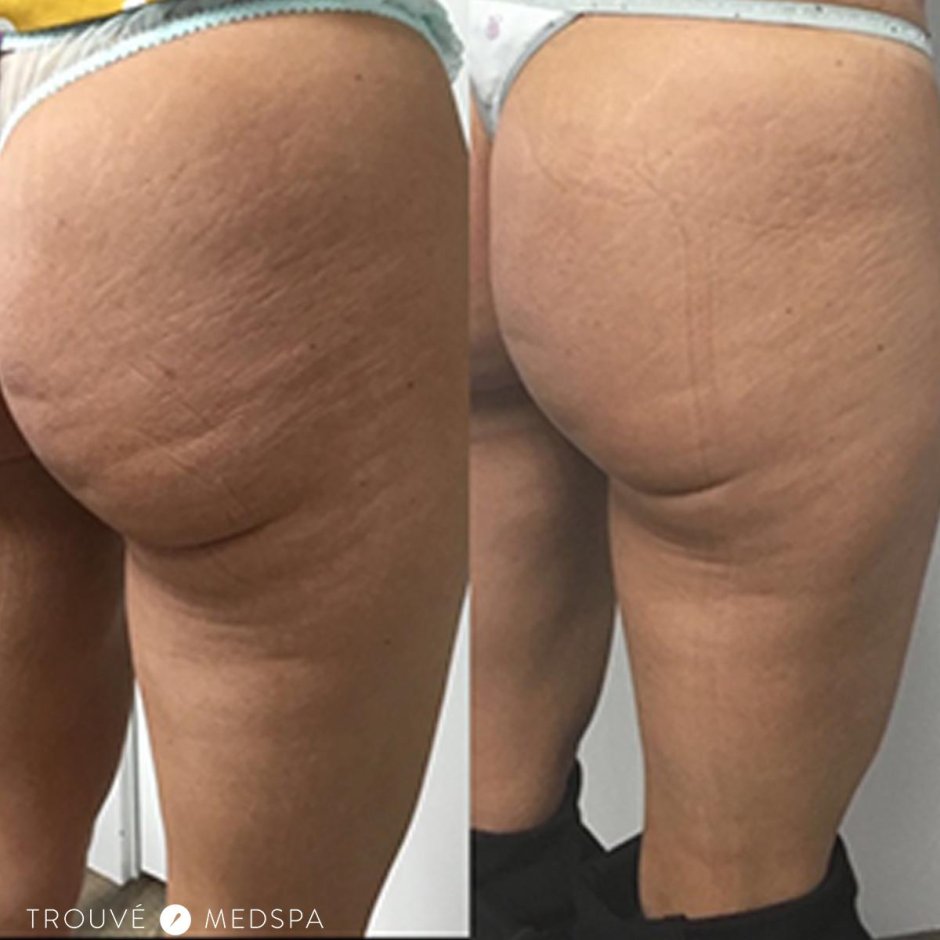 Голые задницы с целлюлитом