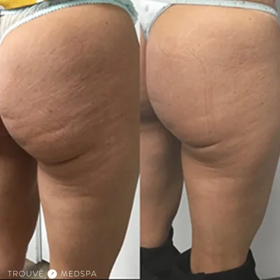 Голые задницы с целлюлитом