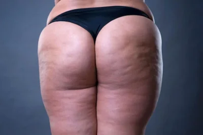 Целлюлит на ляжках