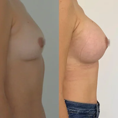 Увеличение груди филлерами