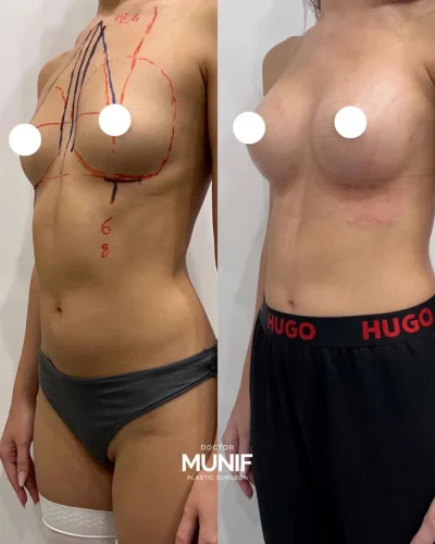 Увеличение груди анатомическими имплантами