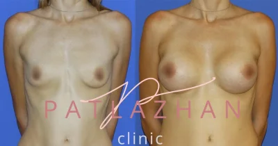 Мужская пластика груди