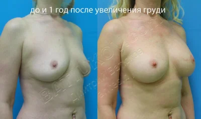 Увеличенная грудь