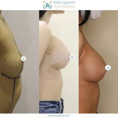 Импланты молочных желез