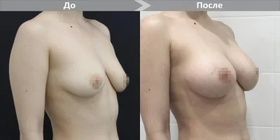 Пластическая операция на грудь