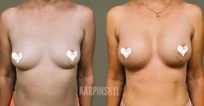 Грудь пластика