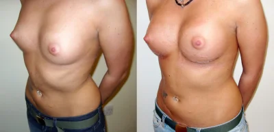 Breast reduction dr. richard