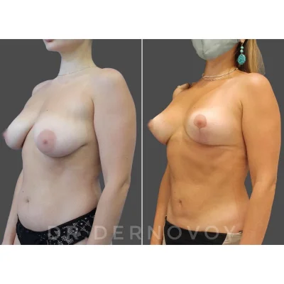 Липосакция груди