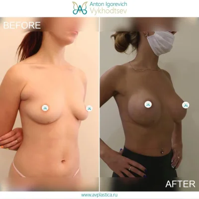 Грудь после увеличения имплантами