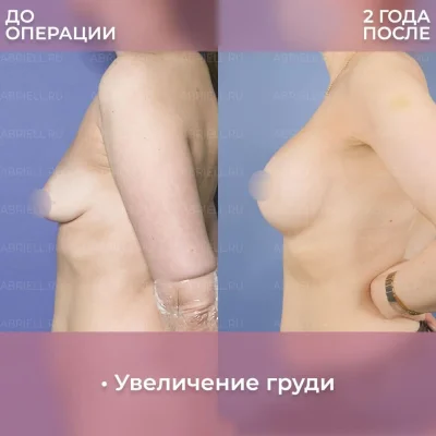 Грудь после увеличения
