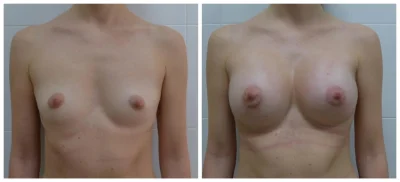 Грудь после увеличения