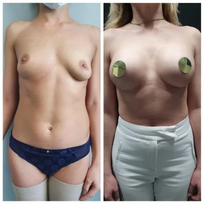 Маммопластика без имплантов