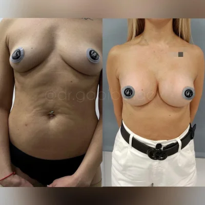 Абдоминопластика и маммопластика