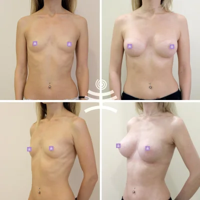 Операция по увеличению груди