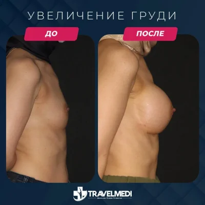 Подтяжка груди до и после