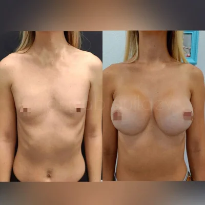 Операция увеличение груди