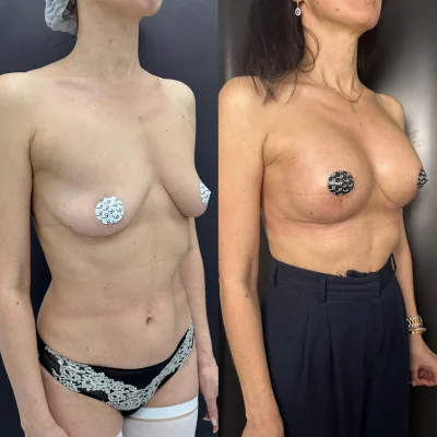 Подтяжка груди