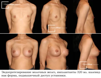 Увеличение груди собственным жиром