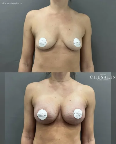 Сиськи с имплантами