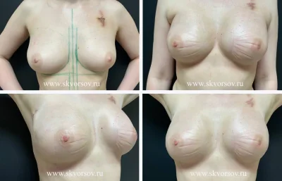 Упругие сиськи после операции