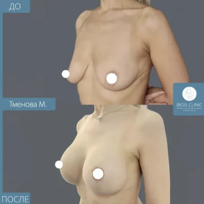 Пластическая грудь