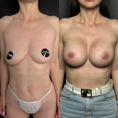 Сиськи импланты