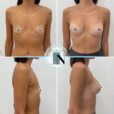 Силиконовая грудь