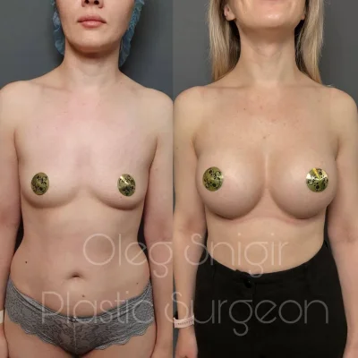 Маммопластика до и после