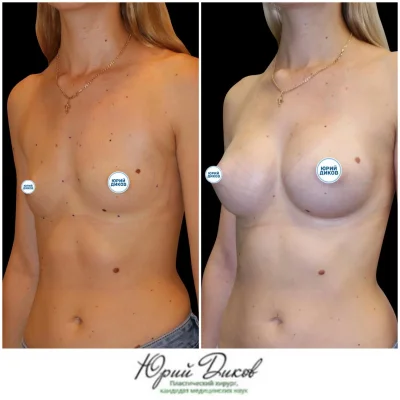 Операция по увеличению груди