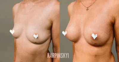 Грудь пластика