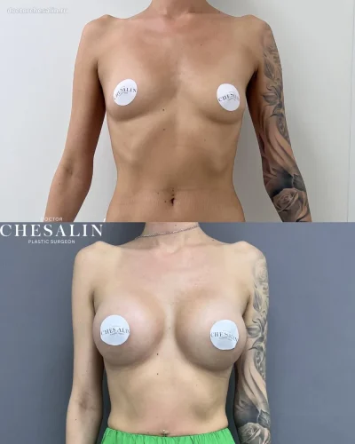 Грудь импланты