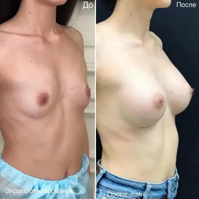 Увеличение груди без операции