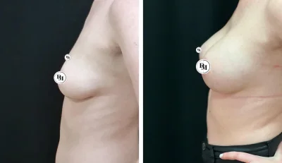 Аугментационная маммопластика