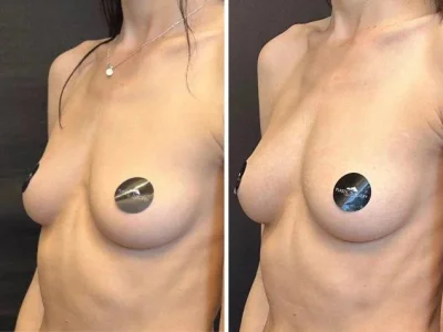 Увеличенная грудь