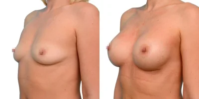 Стоячая женская грудь пластика