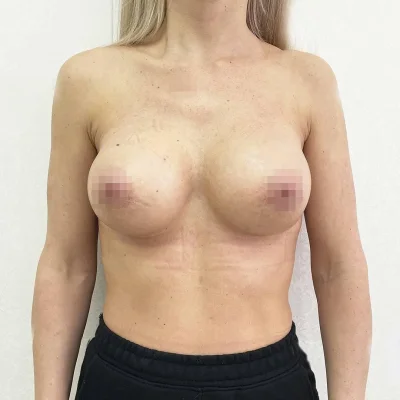 Каплевидная грудь