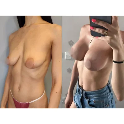 Грудь до и после подтяжки