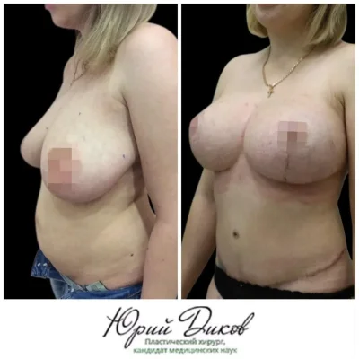 До и после подтяжки груди