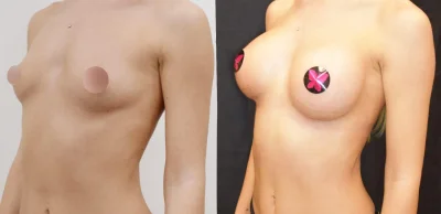 Увеличение грудных желез