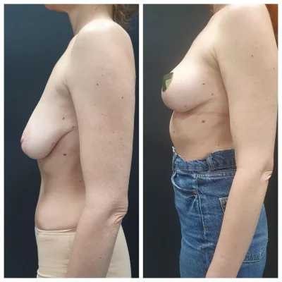 Мастопексия без имплантов