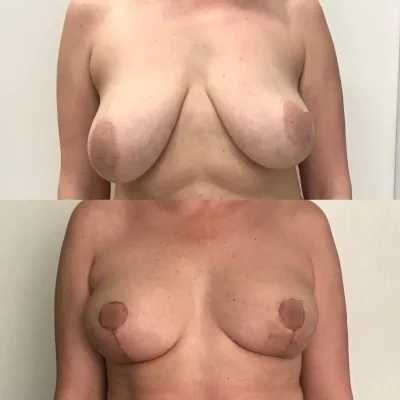 Пластика груди