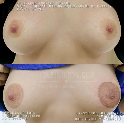 Выпуклые ареолы у женщин